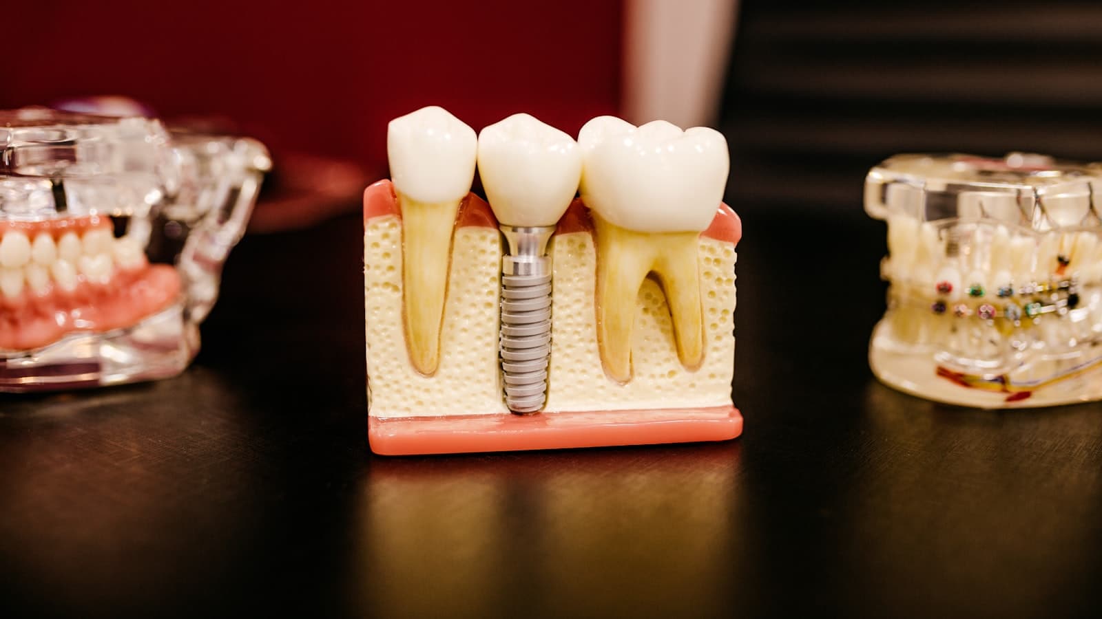 A cross-section dental model showing a titanium implant screw and crown placed between two natural teeth, no people or text.